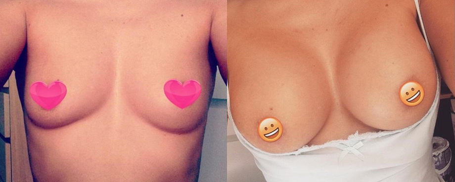 Patient with Breast Implants, before and after