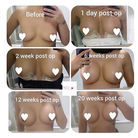 Breast Surgery Recovery