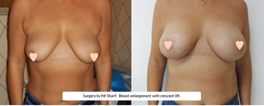 Breast Enlargement Crescent