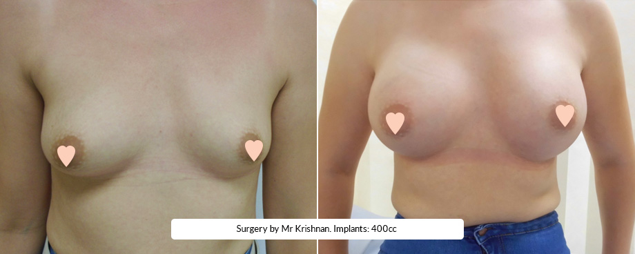 Natural Breast Implants Manchester