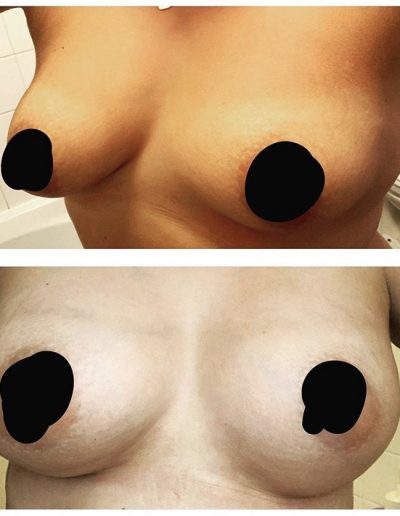 Breast Enlargement and Implants