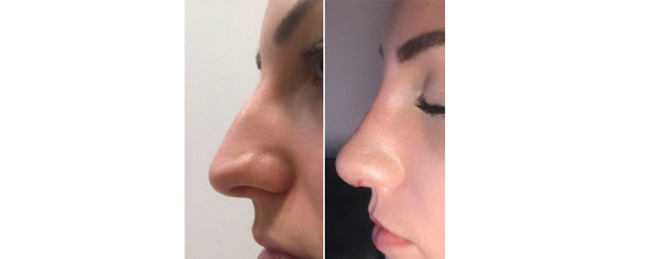 Nose Re-shaping Surgery