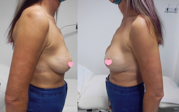 Breast Uplift Surgery