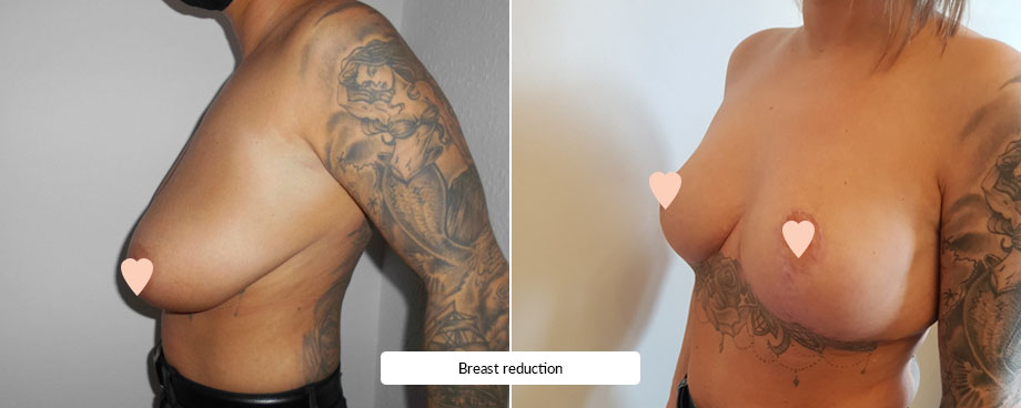 Breast Reduction Before/After