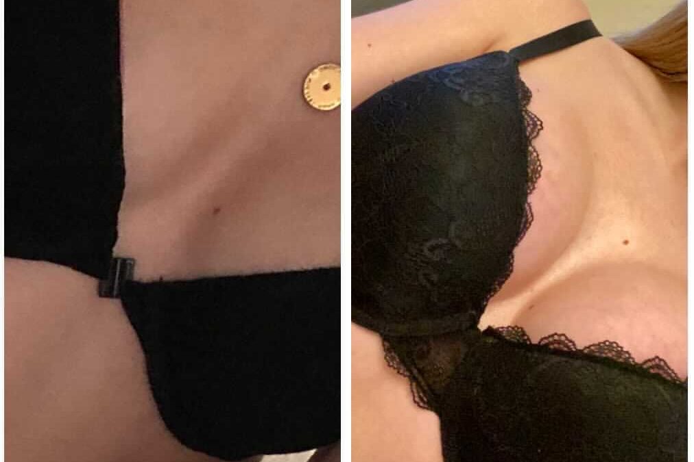 Breast Surgery Before and After Images.